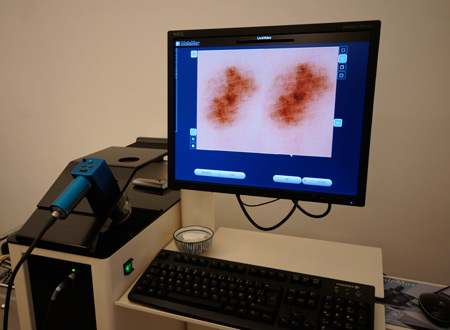 digitalny dermatoskop molemax